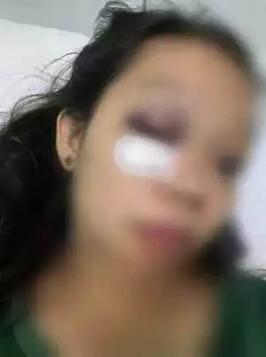 Ungkap Perselingkuhan Suami Berprofesi Polri, Istri Dianiaya Nyaris Buta 